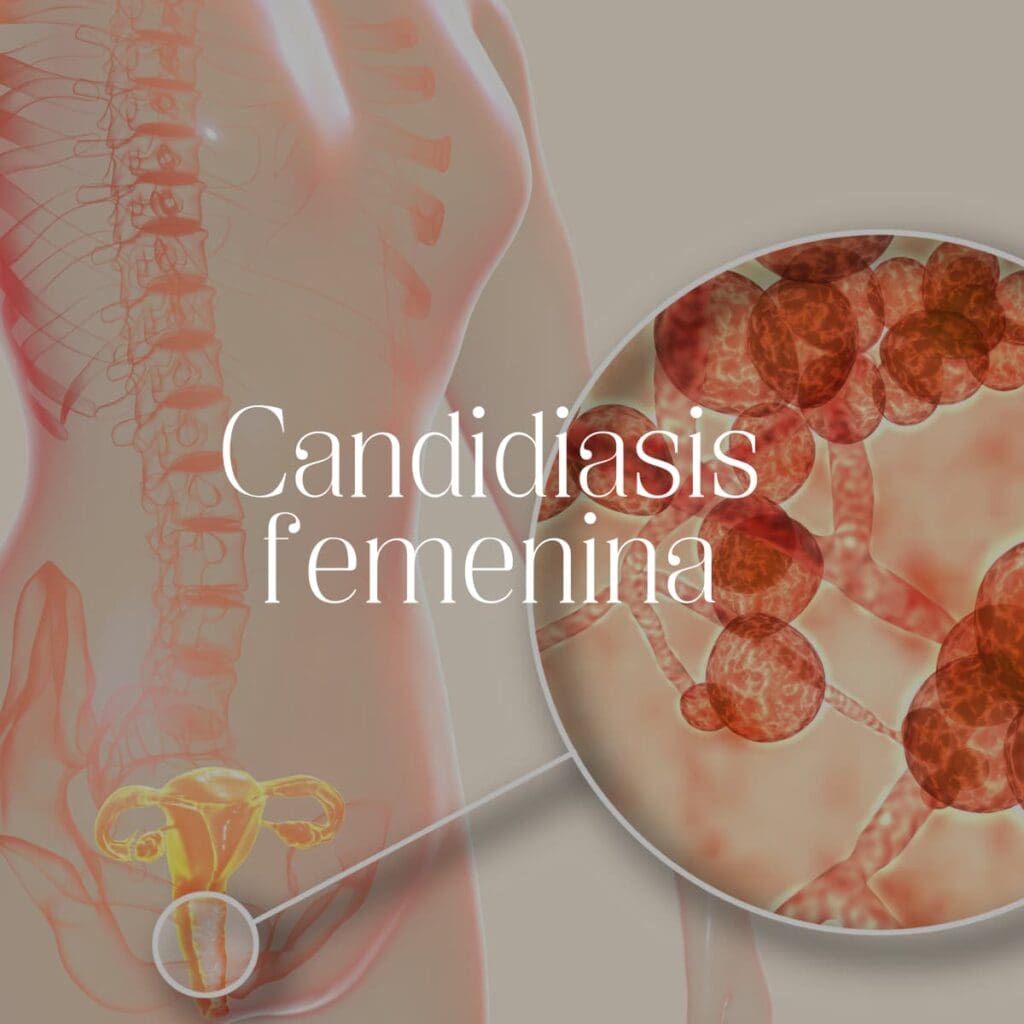 Programa integral Candidiasis femenina